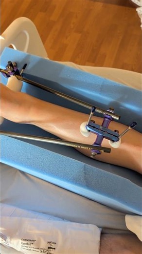 tib fib ankle external hardware #scarred #supercross