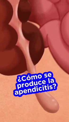 Cómo se produce la apendicitis y su tratamiento