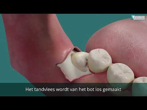 Verwijderen van een verstandskies