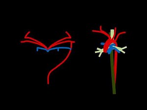 Aortic arch anomalies