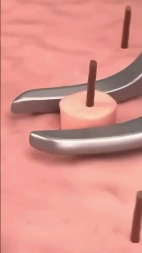 Hair Follicle Extraction - Both Scientific and Real