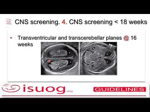 ISUOG guidelines on the sonographic examination of the fetal CNS (part 1)