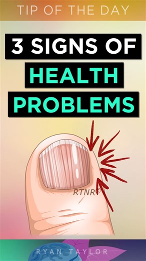 3 NAILS SIGNS of HEALTH PROBLEMS #nailsymptoms #nailridges #verticalridges #clubbednais #nailhealth #fingernais #nutrition #naturalremedy #ryantaylornaturalremedies | Ryan Taylor Natural Remedies