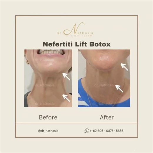 The Nefertiti Lift uses precise Botox placement to relax downward pull, revealing a smoother neck and a sharper jawline naturally. Consultation by appointment dr. Nathasia 📞 ( 62) 895-0877-5856 (WA) ——— #aestheticdoctorbali #baliskinclinic #aestheticclinicbali #nefertitiliftbotox #nefertitibotox | Nplus Juvena Bali