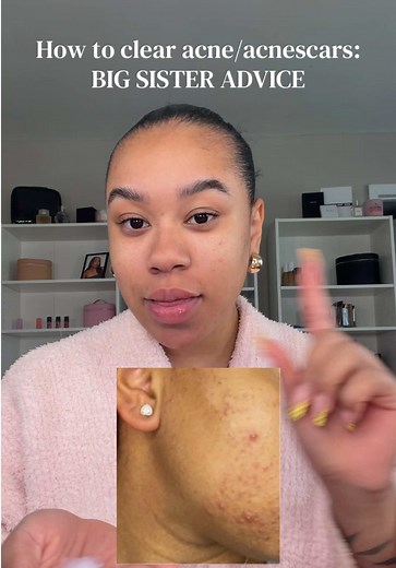 How to Clear Acne & Acne Scars — Big Sister Advice