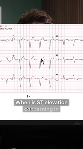 Understanding ST Elevation in LBBB Patients