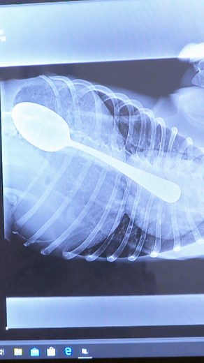 How did this Bulldog swallow a metal spoon?! 🥄😱 #bondivet #dog #bulldogs #bulldoglove #spoon #Shocking #unbelievable | Bondi Vet