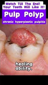 Pulp Polyp (chronic hyperplastic pulpitis) #dentaldisease #pulppolyp #chronichyperplasticpulpitis