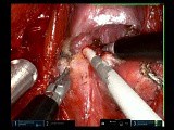 Remote Access Thyroid Surgery with Robot • Video • MEDtube.net