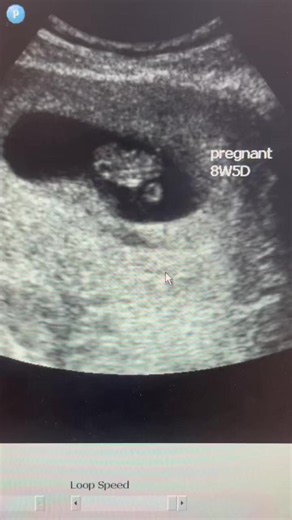 8 weeks 5 days pregnancy on scan