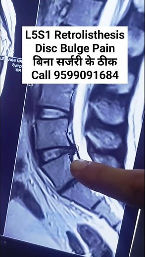 L5S1 Retrolisthesis Treatment Back Pain Treatment Chiropractor Moradabad. #shorts