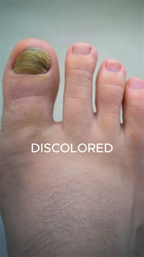 Try this Nail Fungus Remover before you spend another penny on useless creams! | Swissclear