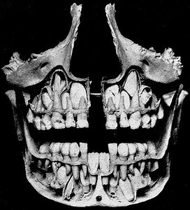 Deciduous teeth - Alchetron, The Free Social Encyclopedia
