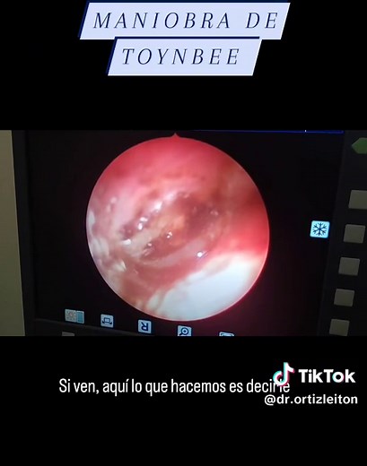 La maniobra de Toynbee nos va a servir como hallazgo objetivo para valorar funcionabilidad de la trompa auditiva. Es decir que hay buen funcionamiento de conexión entre la cavidad nasal y cavidad tímpanica. #droido #drotorrino #otorrino #orl #drnariz #otorrinolaringolo #otorrinolaringologia *Consulta a tu médico, nada de esto iguala a una consulta médica