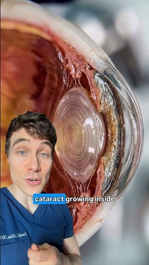 What Cataracts REALLY Look Like (Eye Doctor Explains)