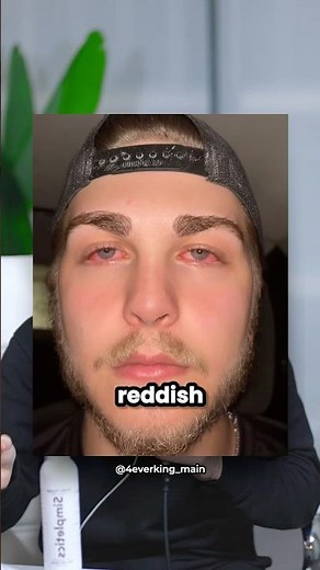 How To Get Rid Of Eye Redness Instantly 😲