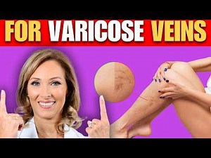 5 Tips For Varicose Veins | Dr. Janine