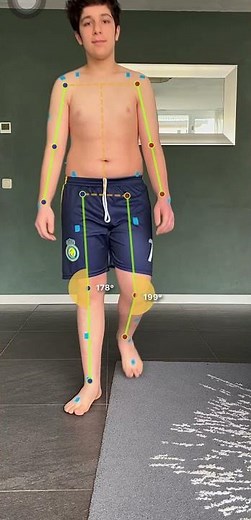 Gait Analysis Frontal View