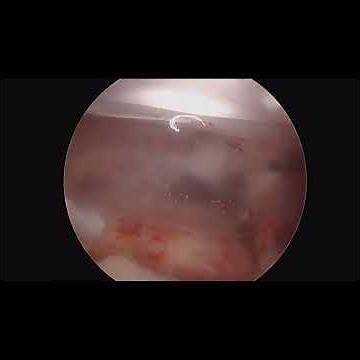 InSpace Balloon Placement