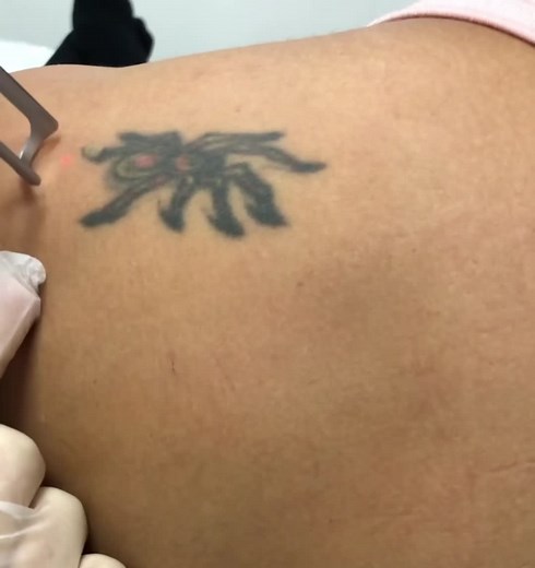 Effective Laser Tattoo Removal Services in Durban