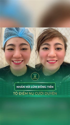 Phân biệt lúm đồng tiền và đồng điếu như thế nào? #ceonhale #nhaleana #jtangelhospital #tuvanthammy