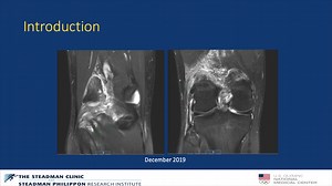 Fibular-Based Technique for Posterolateral Corner Reconstructions