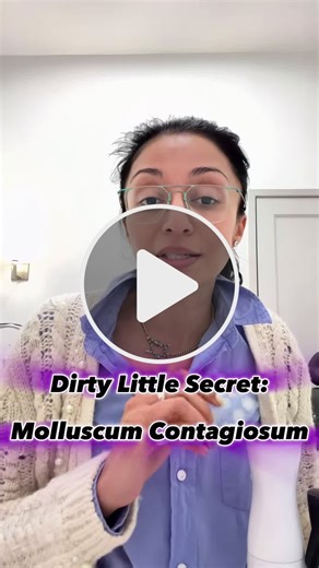 Dirty Little Secret: Molluscum |  If you see tiny, dome-shaped bumps with a central dimple it might just be molluscum contagiosum—a viral skin infection that’s super common in kids.  It can cause issues in kids who are prone to eczema and in those cases you’ll need to see your Board-certified Dermatologist for the proper in-office treatments.  But if you are dealing with a few small Molluscum then this mom hack might be the dirtiest little secret I’ve ever shared.  #DermTok #BoardCertifiedDerm #