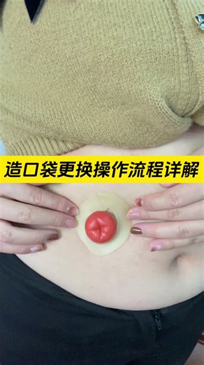 造口袋更换操作流程详解