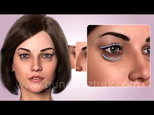 Cosmetic Eye Surgery - Upper and Lower Eyelid Aesthetic-Blepharoplasty. Assoc.Prof.Dr. Guncel Ozturk