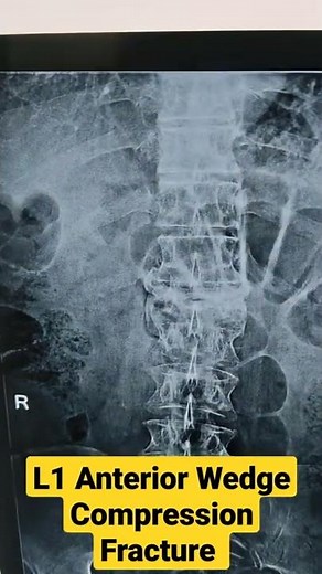 L1 Anterior Wedge Compression Fracture ...Dr Sai Chandra MBBS DNB Ortho