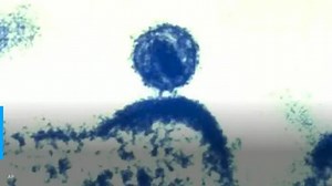 Study finds virulent HIV variant unrecognized for years