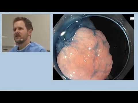 Polypectomy of an ileocecal valve adenoma