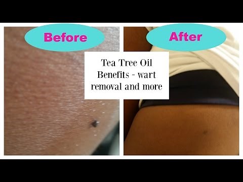 Tea Tree Oil Uses: Wart Removal and More