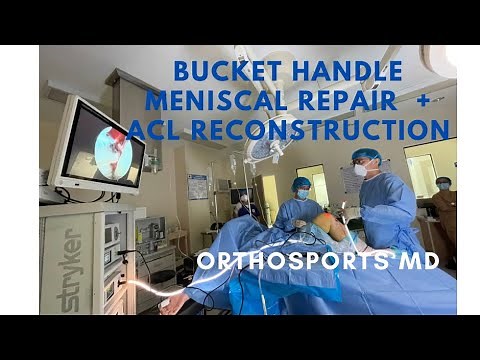 How I repaired a huge meniscus tear. Bucket handle repair + ACL reconstruction