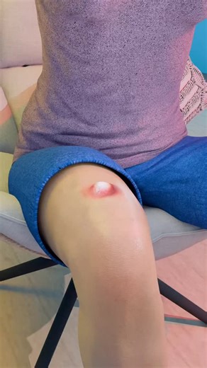 Bio_medicine on Instagram: "A Metal Implant Burst Out Of Her Leg 😱 Credit @zackdfilms"