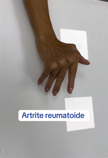 Entendendo a Artrite Reumatoide: Casos Diversos