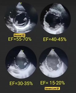 177K views · 1.2K reactions | 易 KNOW YOUR HEART’S PUMPING POWER:...