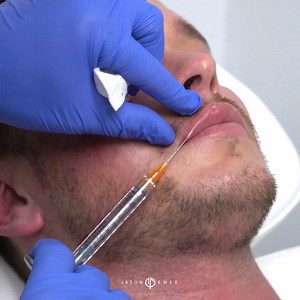 Hydrating Dermal Fillers for Male Lip Contouring