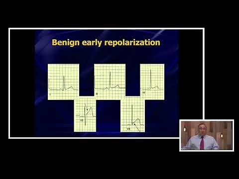 ECG Dilemma: BER, STEMI, or Pericarditis?