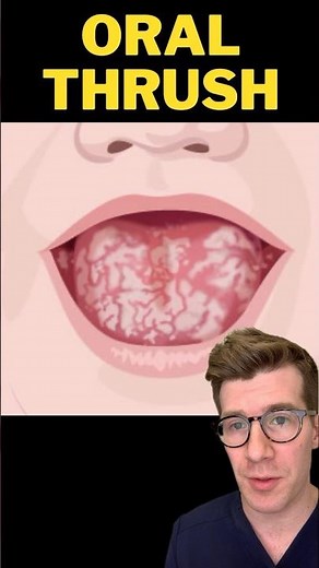 Doctor explains ORAL THRUSH in babies #shorts