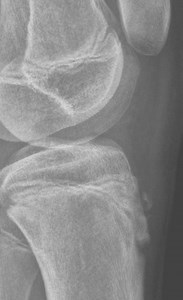 Osgood-Schlatter disease | Radiology Case | Radiopaedia.org