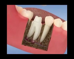 #ENDODONCIA #PERNO #CORONA La corona (funda) es una restauración rígida total, su nombre nos indica que debido a la alta destrucción del diente hay que devolverle su anatomía en forma total. Cuando a un diente se le realizo un #TRATAMIENTODECONDUCTO (endodoncia) y la destrucción de este es muy severa (si la destrucción del diente no es muy severa se puede reconstruir la corona del diente con una restauraciòn tradicional (composite, amalgama, etc) o por medio de una incrustación), el único tratam