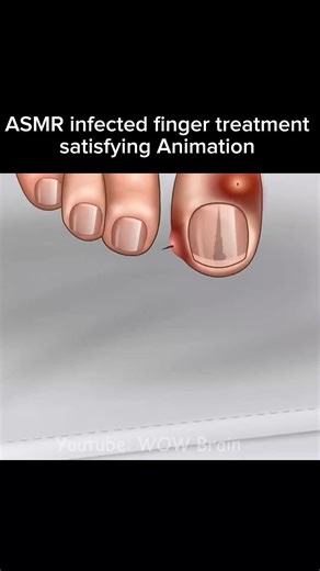 Satisfying ASMR Animation of Infected Finger Treatment