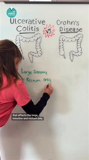 Ulcerative Colitis vs. Crohn’s Disease The NCLEX loves to test the difference between these two inflammatory bowel diseases 📘 💩 BOTH are types of inflammatory bowel disease (IBD) 🥦 Ulcerative Colitis (UC) Inflammation limited to the large intestine rectum only Continuous lesions (no “skipped” areas) Think: ULCERative = ULCERs that are bleeding 🌽 Crohn’s Disease Can affect anywhere in the GI tract (mouth to anus) "Skip lesions" — healthy tissue between inflamed patches Think: Crohn’s = Cobble