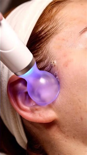 ASMR Dermatology: Left Temple Blackhead Suction (Near Hairline Pores, Visible Clusters, No Talking)