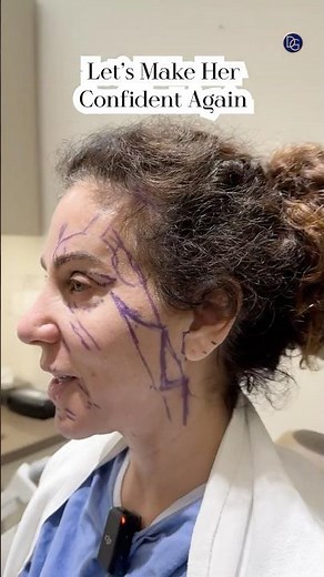 3 Months Post-Op | Neck and Facelift | Before and After #beverlyhillsplasticsurgery