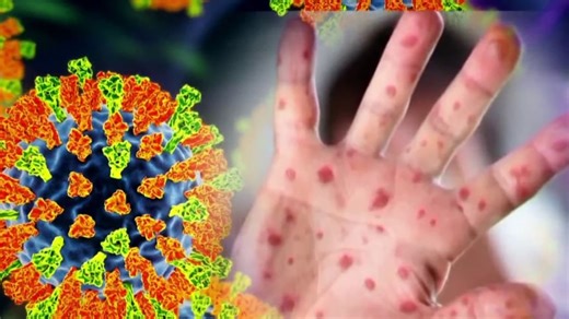 Hundreds of U.S. students quarantined amid measles outbreaks