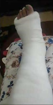 My Leg Cast first cast with Plaster