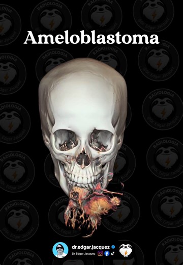 🦷 Un tumor que crece años sin doler y termina deformando la cara. Así se presenta el ameloblastoma: benigno en histología, agresivo en comportamiento. 📌 Lo esencial → Tumor odontogénico más común (junto al odontoma) → 80% mandíbula, 20% maxilar → Pico: 3ra-5ta década, sin predilección de sexo en la forma gnática → 20% asociado a quiste dentígero y diente no erupcionado 🔍 Imagen → Forma multiquística (80-90% de casos): lesión expansiva