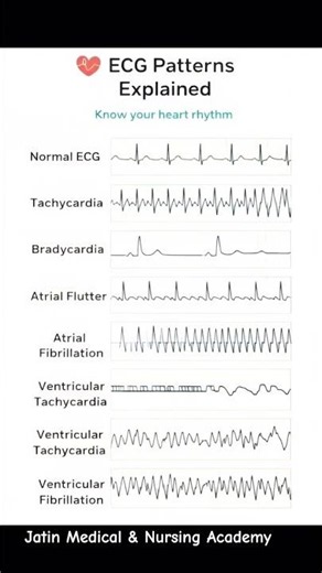 ECG Abnormalities Explained | Tachycardia, Bradycardia, AF, VF, Atrial Flutter & VT Patterns #Shorts